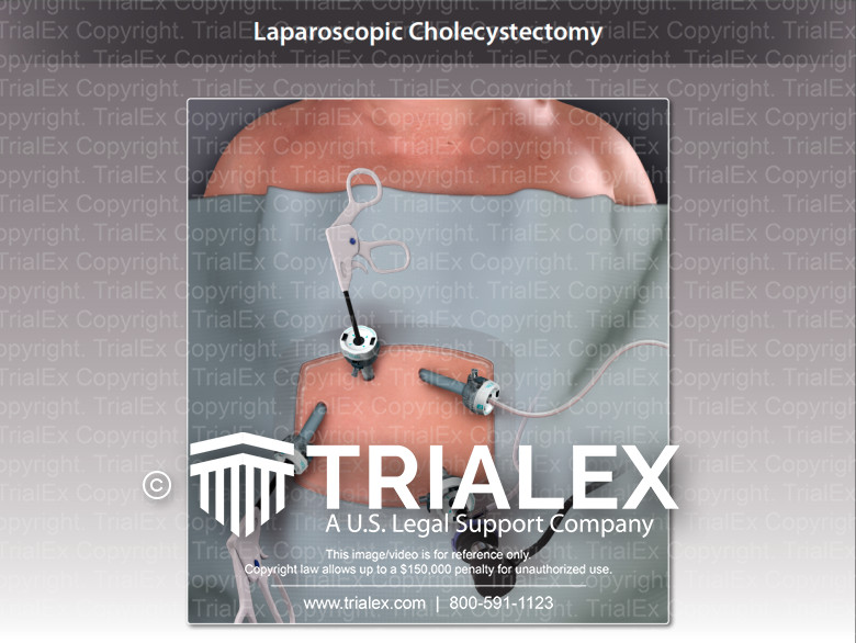 Draping and Trocar Placement For A Laparoscopic Cholecystectomy