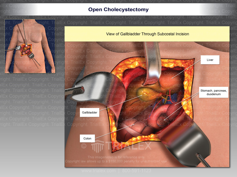 Open Cholecystectomy View through Subcoastal Incision - TrialExhibits Inc.