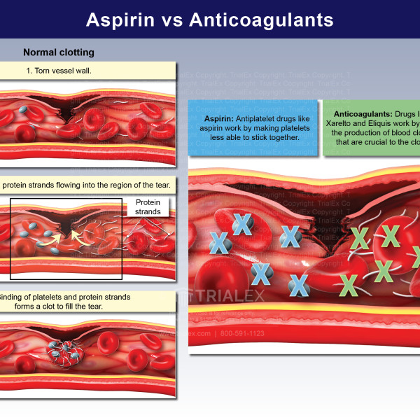 Aspirin Vs Eliquis For Atrial Fibrillation