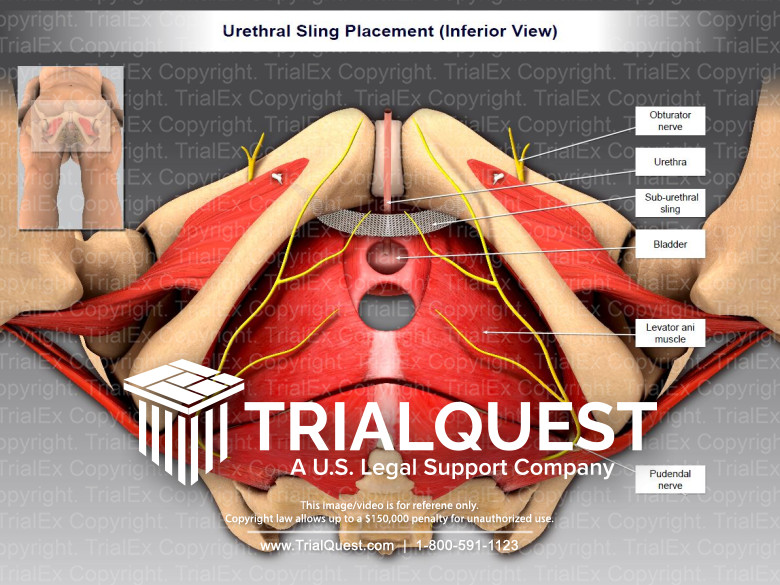 Urethral Sling Placement (Inferior View) TrialExhibits Inc.