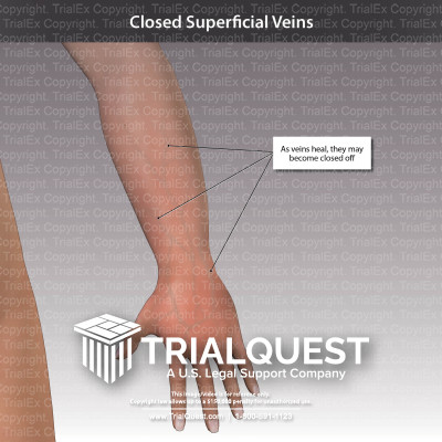 Closed Superficial Veins - TrialExhibits Inc.