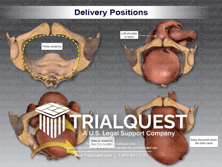 Delivery Positions for Left Shoulder Dystocia TrialExhibits Inc.
