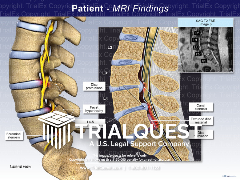 Spondylosis image