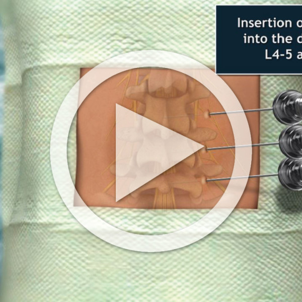 Lumbar Laser Discectomy and Neural TrialExhibits Inc.