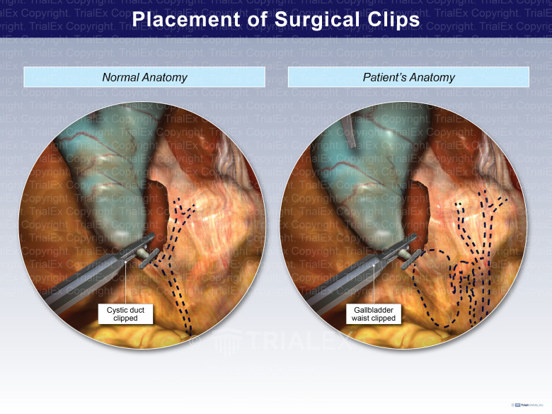 Placement of Surgical Clips TrialExhibits Inc.