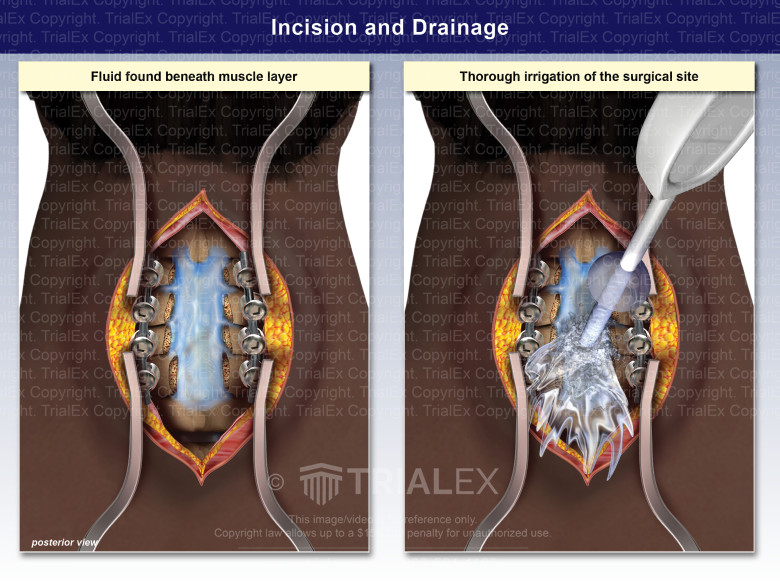 Incision and Drainage TrialExhibits Inc.