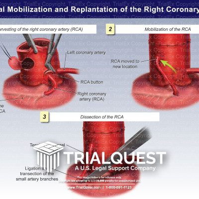 Surgical Mobilization and Replantation of the Right Coronary Artery ...