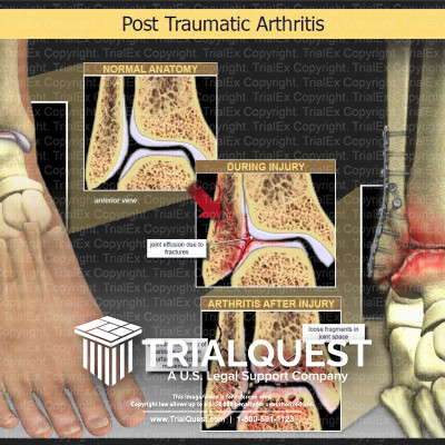 Post Traumatic Arthritis TrialExhibits Inc.