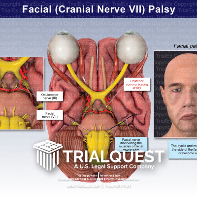 Facial (Cranial Nerve IV) Palsy - TrialExhibits Inc.