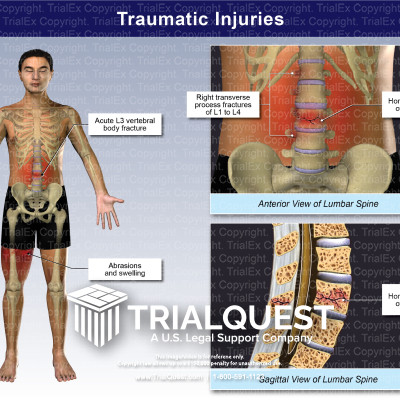Traumatic Injuries - TrialExhibits Inc.