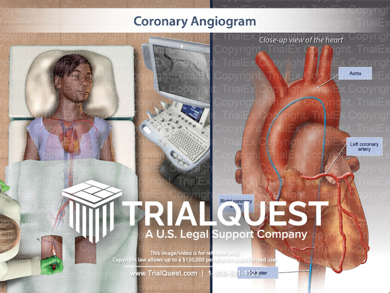 Coronary Angiogram TrialExhibits Inc.