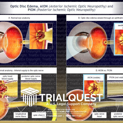 Optic Disc Edema, AION, and PION TrialExhibits Inc.