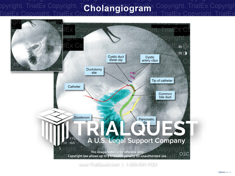Cholangiogramme