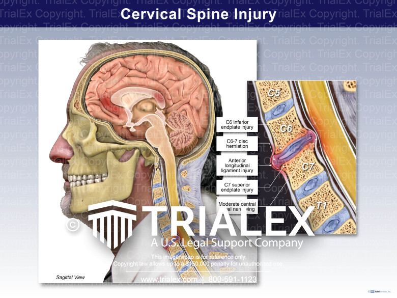 Cervical Spine Injury - TrialExhibits Inc.