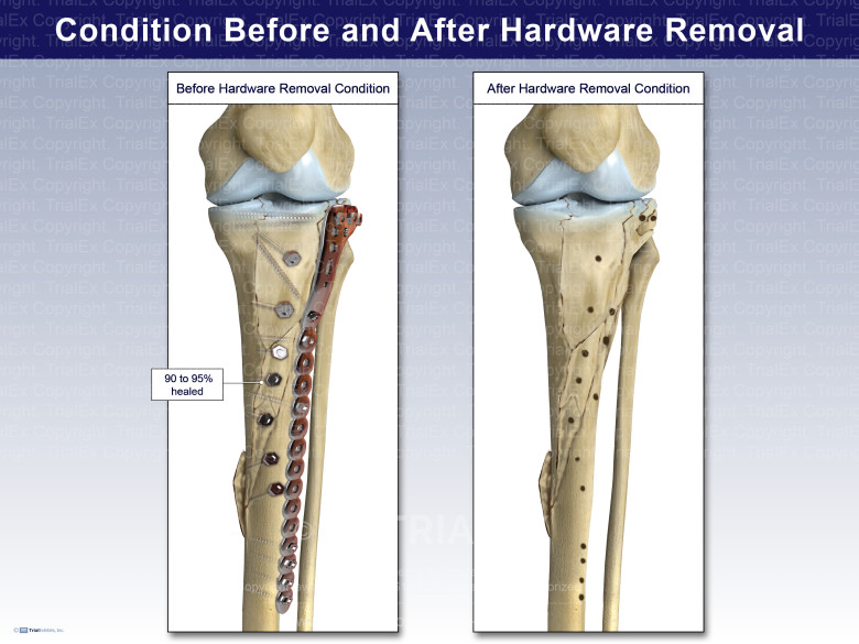 Condition Before and After Tibial Hardware Removal TrialExhibits Inc.
