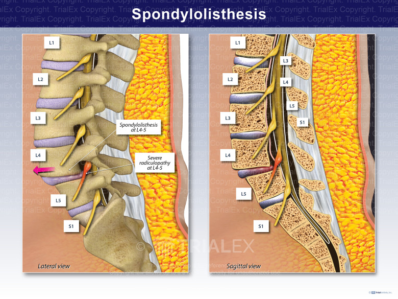 Spondylolisthesis photo of grades picture
