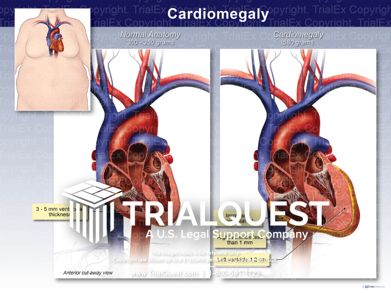 Cardiomegaly TrialExhibits Inc.
